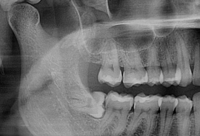 Imagem do curso de Cirurgia Oral Menor