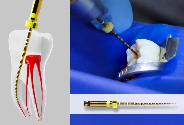 Imagem do curso de Endodontia Automatizad