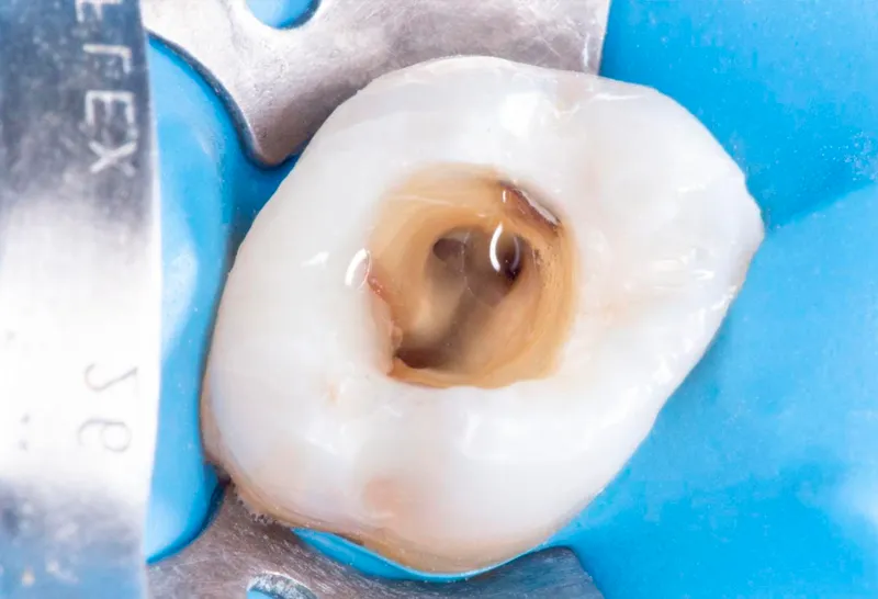 Imagem do curso de Endodontia