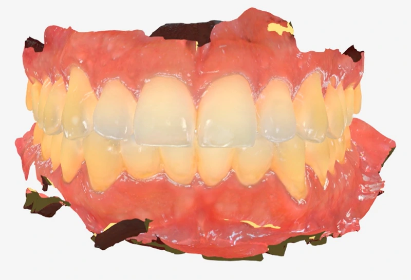 Imagem do curso de Escaneamento Intraoral